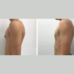 H3-Gynecomastia