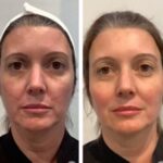 Achieve Natural Facial Contours with the Best Aesthetic Clinic in Dubai for Thread Lift Treatments