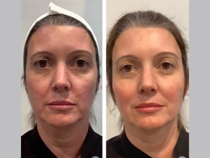 Achieve Natural Facial Contours with the Best Aesthetic Clinic in Dubai for Thread Lift Treatments