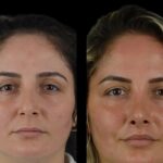 fillers in dubai
