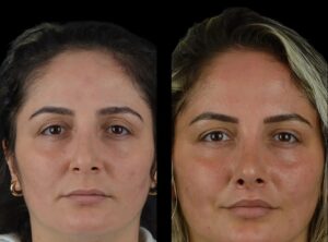 fillers in dubai