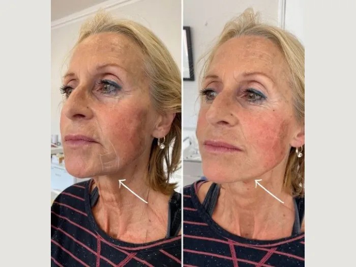 Comparing Endolift Costs at the Best Aesthetic Clinic in Dubai