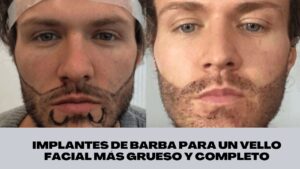implantes de barba