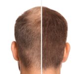 Hair Restoration Dubai: Minimally Invasive Techniques