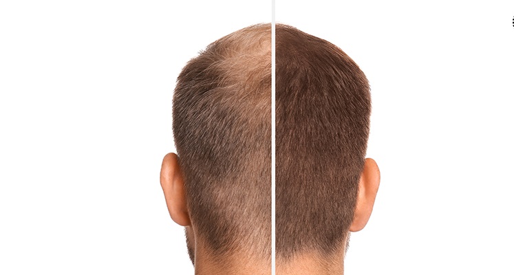 Hair Restoration Dubai: Minimally Invasive Techniques