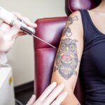 How AI is Revolutionizing Laser Tattoo Removal