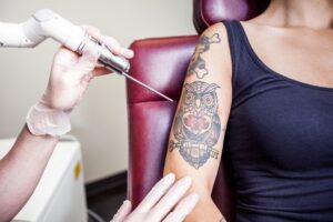 How AI is Revolutionizing Laser Tattoo Removal