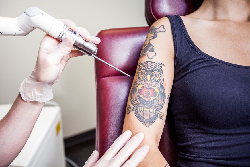How AI is Revolutionizing Laser Tattoo Removal