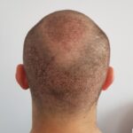 Hair Transplant in Dubai