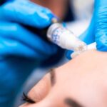 Laser Acne Scar Treatment Restore Smooth Skin