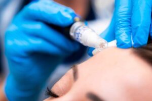 Laser Acne Scar Treatment Restore Smooth Skin
