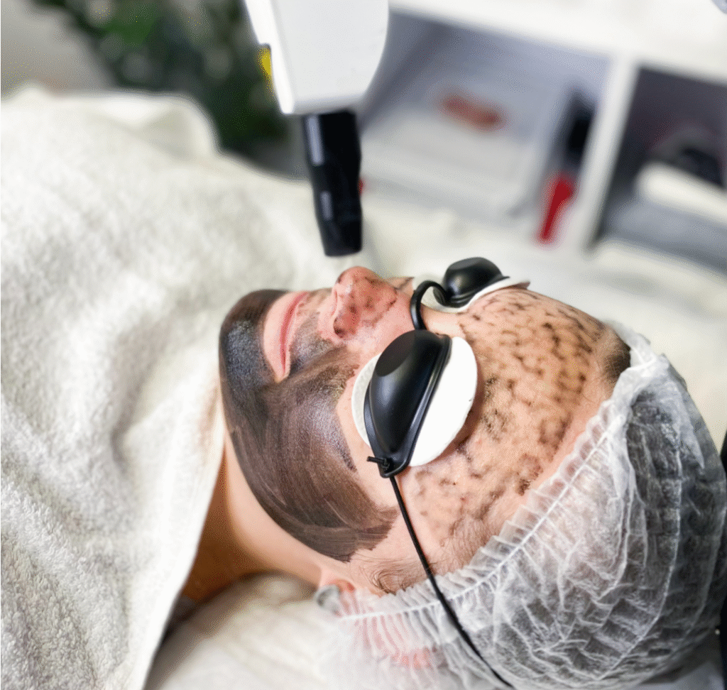 Laser Carbon Peel for Deep Skin Renewal
