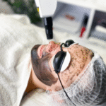 Laser Carbon Peel for Deep Skin Renewal
