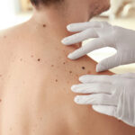 Laser Mole Removal Dubai: Personalized Treatments