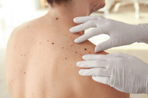 Laser Mole Removal Dubai: Personalized Treatments