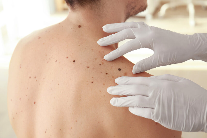 Laser Mole Removal Dubai: Personalized Treatments