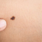 Laser vs Creams: Birthmark Treatment Options