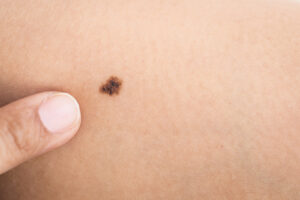 Laser vs Creams: Birthmark Treatment Options