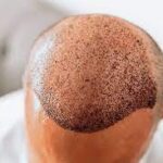 Natural and Lasting Hair Growth with FUT