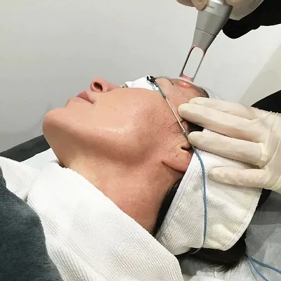 Pico Laser Safe and Effective Skin Treatments