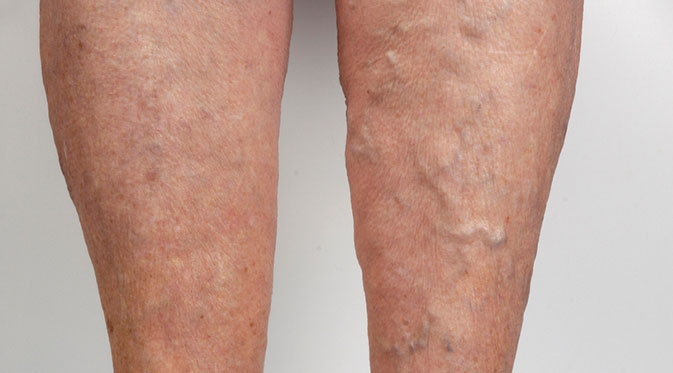 Restore Confidence with Sclerotherapy