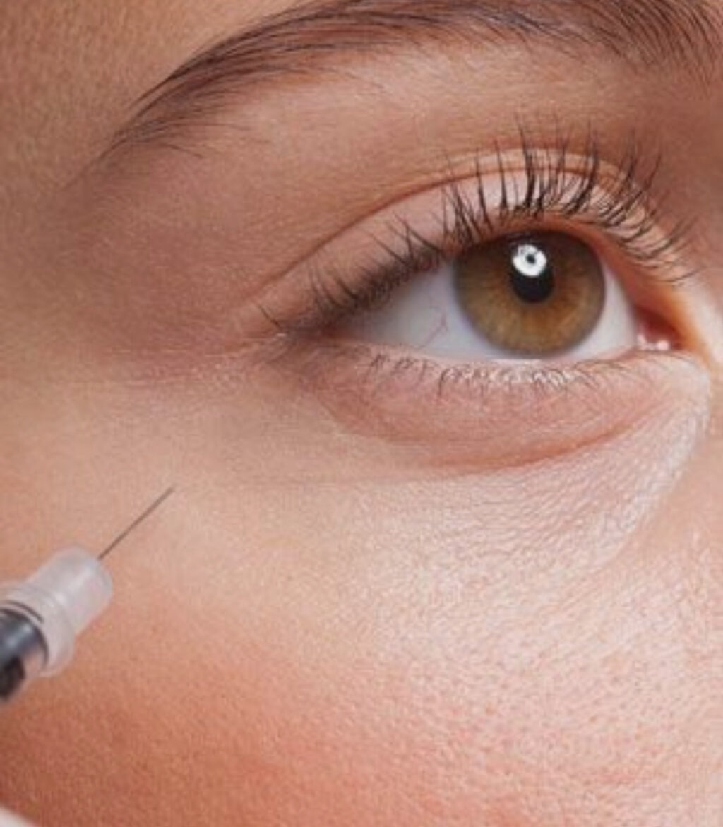 Under-Eye Filler Treatment in Dubai