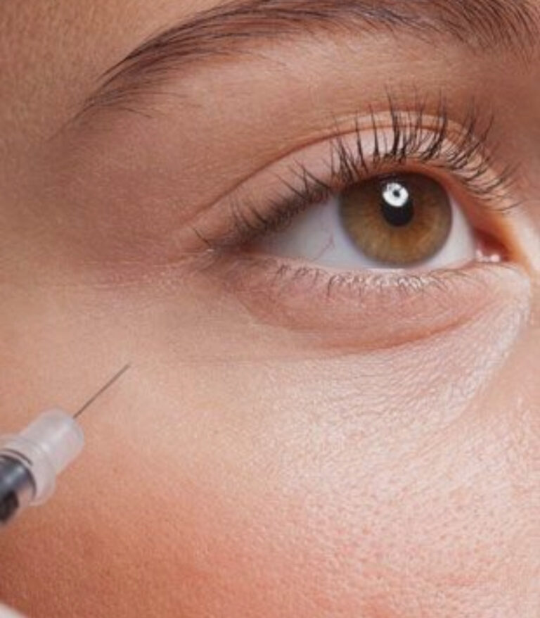 Under-Eye Filler Treatment in Dubai