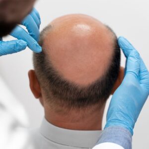 Safe and Effective Hair Regrowth with FUE