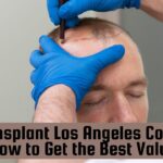 hair transplant los angeles cost