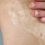Transform Your Recovery with Burn Reconstructive Surgery