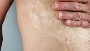 Transform Your Recovery with Burn Reconstructive Surgery