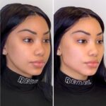 Thread Lift Treatment in Dubai: A Revolutionary Approach to Facelift Alternatives