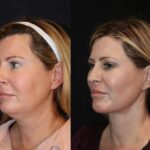 In Dubai Offering Premium Skin Tightening Treatment in dubai