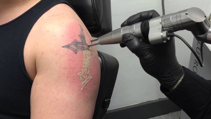 Why PicoSure Is the Gold Standard for Tattoo Removal