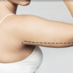 arm lift