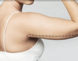 arm lift