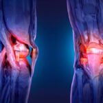 perils-of-delaying_knee_replacement_dr_smith_orthopaedic-1080x675