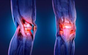 perils-of-delaying_knee_replacement_dr_smith_orthopaedic-1080x675
