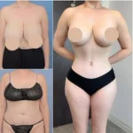 labiaplasty in dubai
