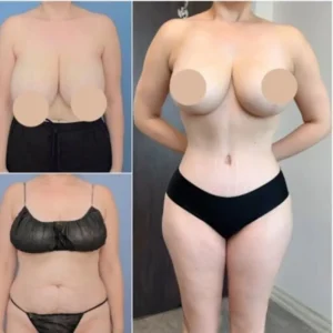 labiaplasty in dubai