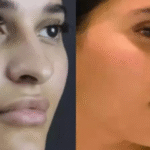 septoplasty in dubai