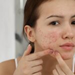 Best Pimples Treatment in Dubai