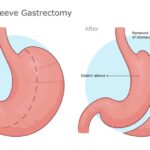 Modern Weight Loss Treatments with Gastric Banding