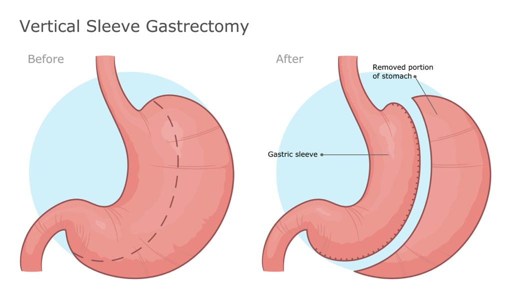 Modern Weight Loss Treatments with Gastric Banding